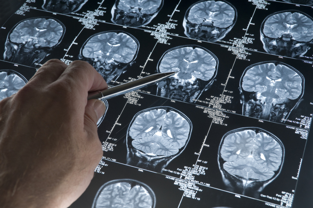 Stimulating the Blood-Brain Barrier Can Help Patients with Alzheimer's Illustration for news: Stimulating the Blood-Brain Barrier Can Help Patients with Alzheimer's
